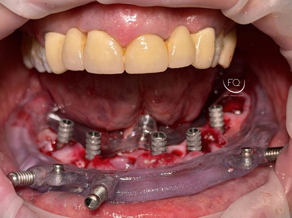 Chirurgia Guidata con Dima scomponibile - 7