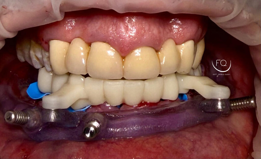 Chirurgia Guidata con Dima scomponibile - 8