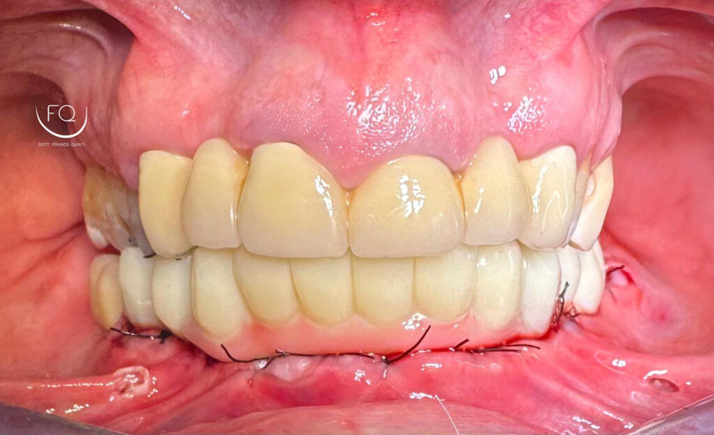 Chirurgia Guidata con Dima scomponibile - 9