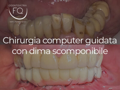 Chirurgia Computer Guidata con Dima scomponibile