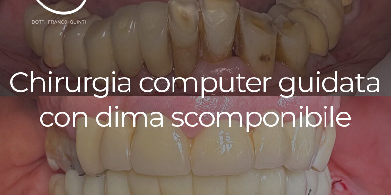 Chirurgia Guidata con Dima scomponibile - 22 gennaio