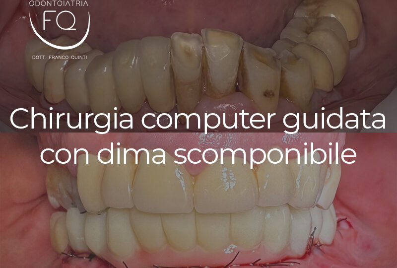 Chirurgia Guidata con Dima scomponibile - 22 gennaio