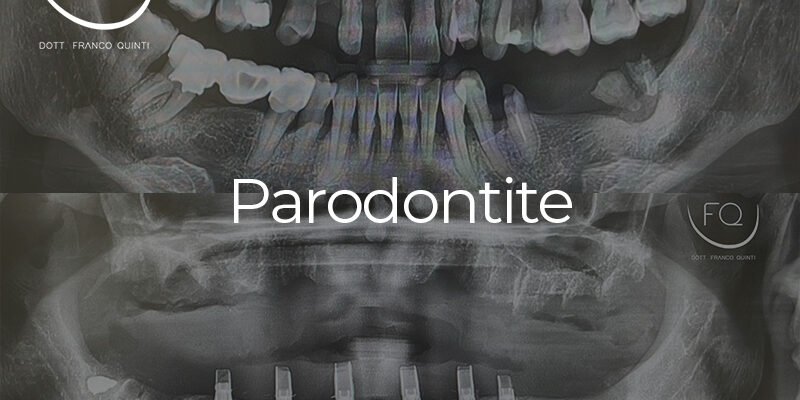 Parodontite - 11 febbraio