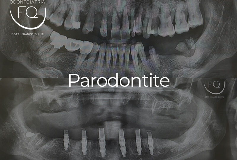 Parodontite - 11 febbraio