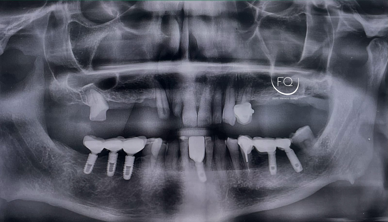 Chirurgia Computer Guidata superiore - 1