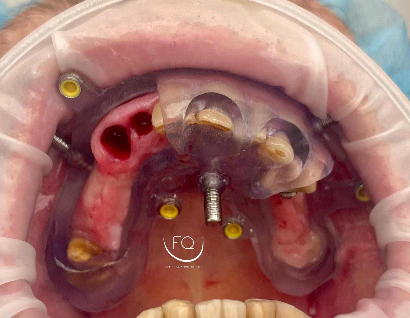 Chirurgia Computer Guidata superiore - 4