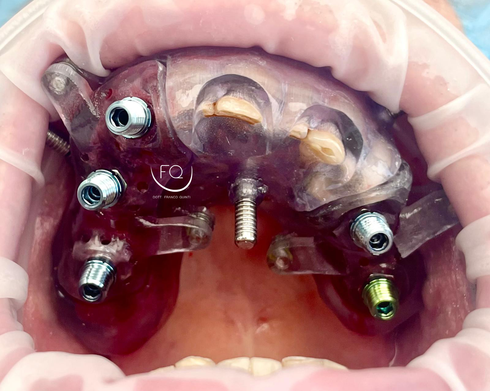 Chirurgia Computer Guidata superiore - 5