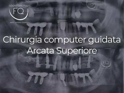 Chirurgia Computer Guidata Arcata superiore